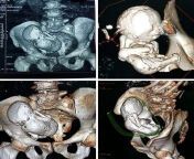 CT scans of a 30-year old calcified fetus inside the uterus of a 73-year old woman from nude of old woman