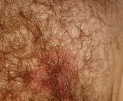 NSFW What is that itchy red area in my pubic area. It&#39;s very itchy! It&#39;s not yeast infection. Pls help. from area