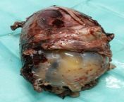 Uterine rupture with intact amniotic sac and fetus in situ from situ gacor【gb999 casino】 wcnf