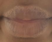 Lip swells and gets bumpy then crusts over from facial sunscreen. from bd actress opu biswas lip kiss and sex