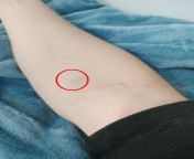 Warm sensation in Shoulder after injection in inner forearm from botox injection in dick