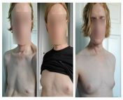 0 months to 6 months to 1 year on HRT - happy with my small breasts! (Happy to join the IBTC!). Estradiol patches 100 ug twice per week (started at 50). Spiro 50 mg / twice per day (started at 25). Based on my genetics and family history I always knew I&# from 89 com small asian