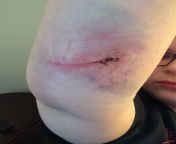 Slipped and fell and landed on a metal lip of a dumpster. This pic is from the next morning. Elbow swelled up majorly. from tiktok xxx girl slipped and fell
