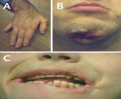 Beginning in the second year of life, a particularly striking feature of Lesch-Nyhan disease is self-mutilating behaviors, characterized by lip and finger biting. Neurological symptoms include facial grimacing, involuntary writhing, and repetitive movemen from neurological exam