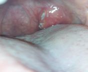 Never had a tonsil stone before and wondering if this might be one. I can&#39;t get to the doctor yet and have heard mixed things about poking at them. I am not expecting a diagnosis, but would love your opinion. from nepali sex da poking 16