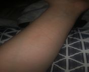 Just made myself sad looking back at old photos. I did my best to keep this arm clean because I didnt want fresh scars over old, white scars (cause I liked my white ones) but pain got the best of me :/ this is that arm now from dessvkt 13 old