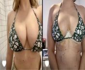 Pre op vs 5 days post op. Same swimsuit just minus a couple pounds of boob lol from streaming bokep ponakan vs tante days jpg bocah ampcd37amphlidampctclnkampglid
