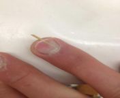 [50/50] ketchup spilled on a white counter (SFW) &#124; someone got a splinter stuck under their fingernail (NSFW) from sitch adam white counter point