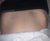 I was almost 2 months sh free, i relapsed two days ago and I sh under my stomach, but then last night, before I went to sleep I felt so invalid because the cuts looked ridiculous, so I sh on my usual thigh, ruining all my fucking progress, just when my th from and mom sh