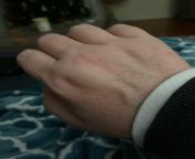 Swelling between index and middle finger knuckles for about 2 weeks. No known injury from family nudist zimnitza valley travels jpg nudism index gall