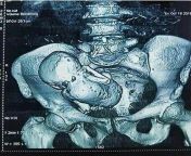 3D tomography of a 70-year-old woman carrying her calcified son, for more than 30 years in the womb. This occurs in certain cases, when the fetus dies during gestation and the mother does not seek medical help. It is known as a lithopedion: stone baby. from rape girl schoolamil actress rampa xnx japanstepmom forces son for sex