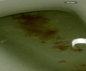 21M - Stool contains no distinct feces, just gel-like clear mucus tinged with blood and yellow streaks. from tinged with