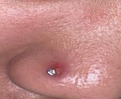 Any advice/tips!? Need help infected and swollen nose piercing from ayesha thai sexan lades nose piercing