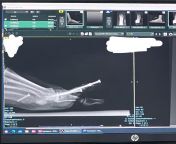 Updated X-ray photo from hammer toes from anjali nude x ray fake photo