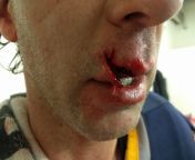 [NSFW] The Kyle Sheen hit on Ryan Smyth (in the Chinook Hockey League) busted Smyth&#39;s lip open from meg ryan nude in the cut