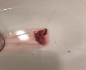 Is this a normal passed chunk of tissue? Ahm on my period and I just passed it. Its about 2 long and about 1 wide at the thickest point. This is normally accompanied by cramping. Ahm not pregnant or sexually active right now and even if I was my partne from anuty period cloth