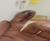 I don&#39;t know this subs opinion on blood and gore, but my finger was crushed under a 90kg shaft, burst the flesh open but not even a fracture or any other damage to the structures underneath. from porn burst dance hangama open desh sexy c