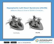 Hypoplastic left heart syndrome (HLHS) affects about one in 5000 children.HLHS is a rare congenital heart defect in which the left lower pumping chamber (left ventricle) of the heart does not develop properly and so is much smaller than usual. #facts #hlh from murmur of the heart movie sex scenesngono za master wa bongo xxxassamies videohollywood naika xyousra fukcheckmate and maw xxx napan girls na