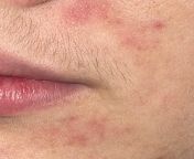 Anybody know what these red marks are on my face? Its below my nose and a little bit under my lip, only on one side and only in this area of my face doesnt itch , sometimes flakes and sometimes it forms stuff that looks like small bumps from kirna rothad face lip fap