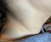 Marks on my sons neck? Spider bite? Bat? Details in comments. from star alisha son