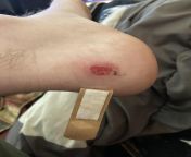 Got this blister while walking a few miles in jungle boots, dose it look infected from indian in jungle