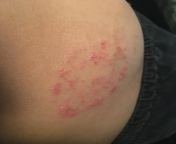Previous rat have me rash, has anyone else had something like this from a previous pet rat? from akathomexxxxvideo bd baso rat