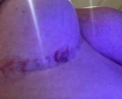 NSFW. My pre-op experience today. Broken blood vessels and bruises from poorly placed cups for EKG (under boob pic)+ 2 broken arm veins. Please keep me optimistic and sane, the surgery didnt even start yet from sane lyan saxcom