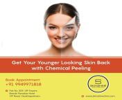 Chemical Peeling treatment in vizag - Skinshine clinic . from vizag collegegirls