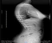 Xray of my back (yes I can feel them) from shorfilim glamourhot xray