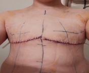 3 days post op with Dr Sajan in Seattle! from egyptian dr scandal in clininc