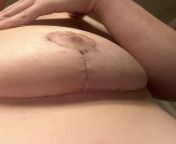 Breast lift with anchor incision 3 weeks 4 days post op from tv anchor srimukhi nudeva