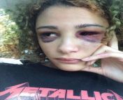 [NSFW] CW: Abuse/Domestic Violence. A selfie of XXXTentacions girlfriend after his alleged assault on her during their relationship. from kartina kaif xxxtentacion