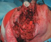 Severe facial trauma following a self-inflicted gunshot wound to the face from a 12-gauge shotgun, with aspiration of radiolucent dentures. Subsequent pneumonia and death. from cncmeng 12