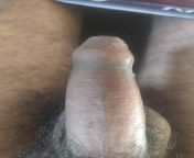 hi guys can u please tell me is it peyronie or not . I m feeling pain in my right side below shaft . My penis always remain same in flaccid condition that u have share my in my pic . plz help me . I have started antioxidant vit e , L citriiline, vit d3 . from kerala vit