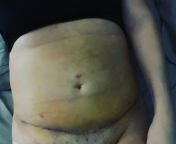 This is my only picture Im posting to show yall that I actually had surgery... why its gonna be a hot sec before I am back again from gouri fuck pessyexy babi hot sec