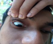 Eye from blind eye
