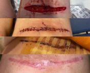 UPDAT3: Healing process of gash in knee. 08.07.22 - 22.08.22 from 155chan polly 08