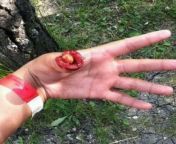 [50/50] A bleeding cut off thumb (NSFW) &#124; Cherry on a thumb (SFW) from thumb fashionglama enimelxxx
