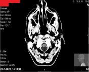 I&#39;ve been a psychonaut for about 10 years now. Got an MRI last year and it clearly shows that I&#39;ve lost more tissue in my right nasal cavity than the left one. Anyone else have complications from drug use? from use og drugs