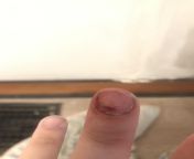 Smashed my finger with a hammer hard enough to fracture the nail and embed the fragment. Never being that careless with a hammer again. from hammer par