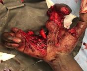 Mans hand was split in two after a lit firework exploded before he could throw it at a party! - Full case from japanese party full