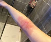 eczema seems to be infected once again gotta wait until monday to see a doctor. yes its as painful as it looks. feels like ants are crawling under my skin from doctor rape kajri s