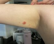 What is this? Hi. My wife has this red spot on her arm. Does anyone know what it is? Shes not sure if she needs to go to the doctor to get it checked out so any advice would help. Thanks! from doctor spot