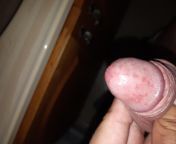 20, male. Not the first time I&#39;ve had this, and it&#39;s only happened after having sex and not washing afterwards. First time went away after use of fungicidal cream. No pain/sensitivity, but its worrying to look at. Is it just Balanitis? Should I se from www cartoon mom sex video school girls xxx first time rape download