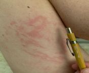 I crushed a june bug that had crawled into my pant leg, and now I have a painless rash on my thigh in the same spot. Coincidence? from i fucked a random guy on my weekend in paris and let him cum on me eva elfie