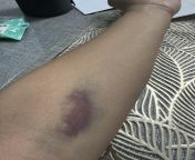 I went to the hospital because I was in a lot of pain and they gave me an IV I was left with this after from iv 83net jp models 27 nudemonal gajjar