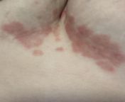 (Stock photo) rash under breast from jerrww rash