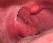 What is this growth on the back side of my right tonsil? from teen fuck back side of