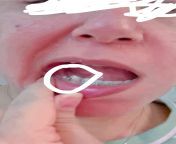 Is my braces broken? I noticed tiny ball on the tip of the wire after I ate what is it ! ? It is just one week from braces motherless tongue tiny
