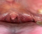 Frequent one sided sore throats, tonsil stones, LOUD snoring that isnt corrected by sleeping on side. My one tonsil appears larger than the other. Would removing my tonsils help? from than sex fuck xxx removing